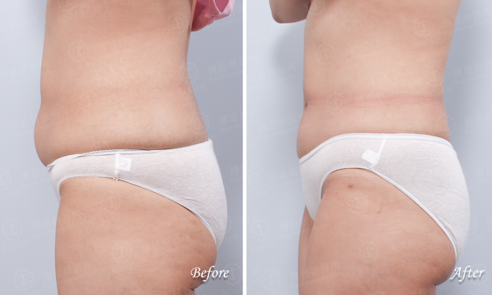 腹部抽脂,瘦小腹,博恩妍